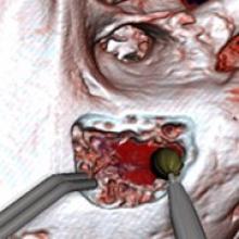 Temporal Bone Surgery Simulation